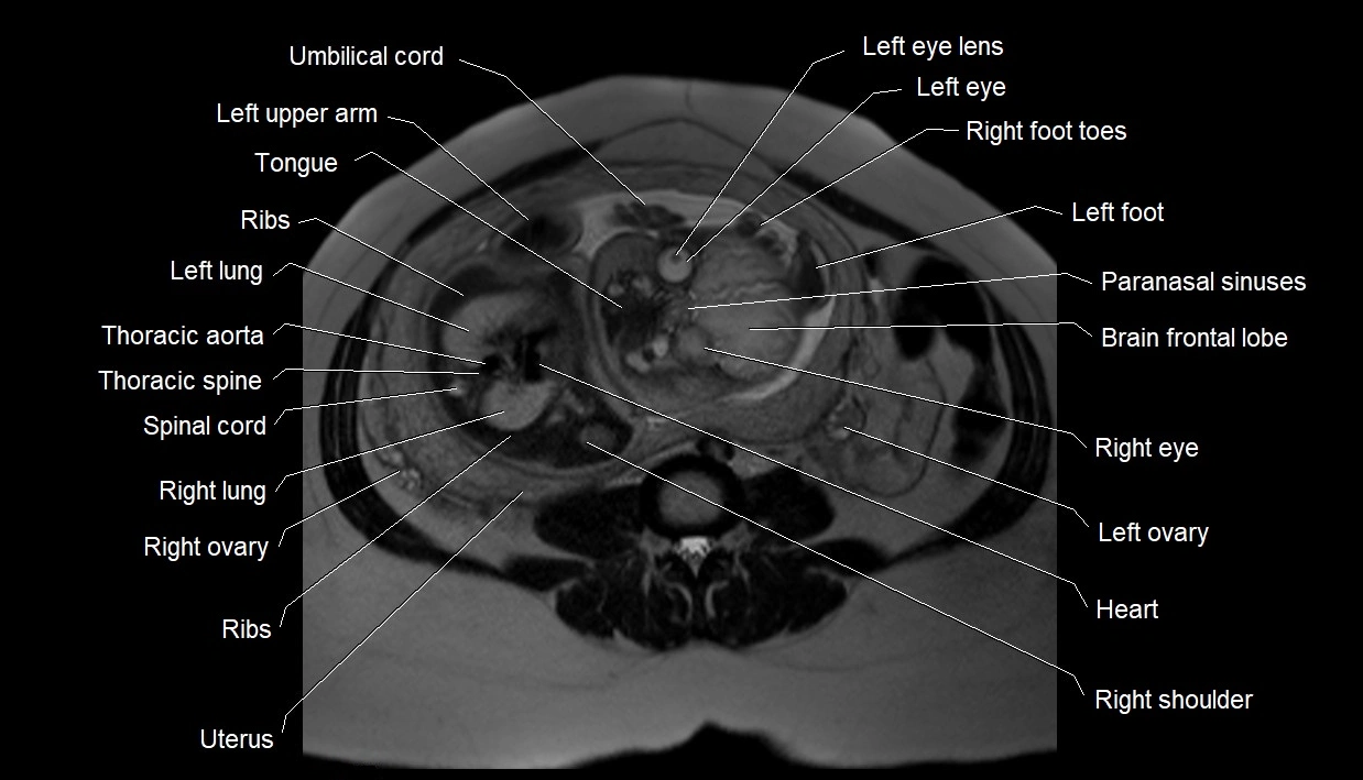 MRI fetal anatomy axial image 16.webp